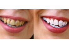 blanqueamiento dental