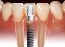 implante dental